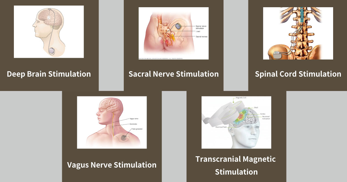 Neuromodulation types