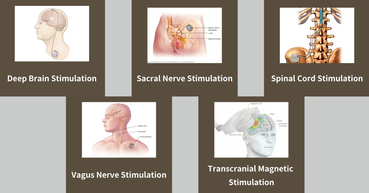 Neuromodulation